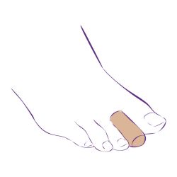 СТ-66 (L-35 мм) Приспособление корригирующее (тканевый колпачок)