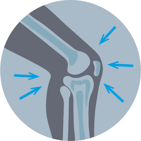 Улучшенная стабилизация сустава